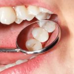 a comprehensive look at who should get dental sealants and why
