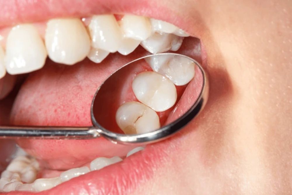 a comprehensive look at who should get dental sealants and why
