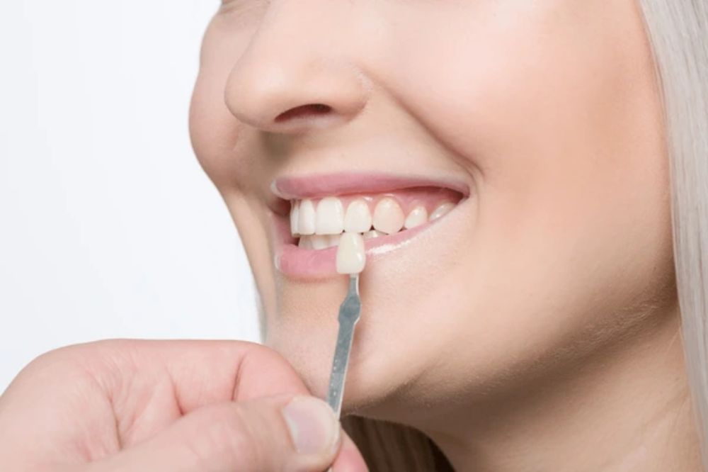 how to care for your veneers tips for a long-lasting smile