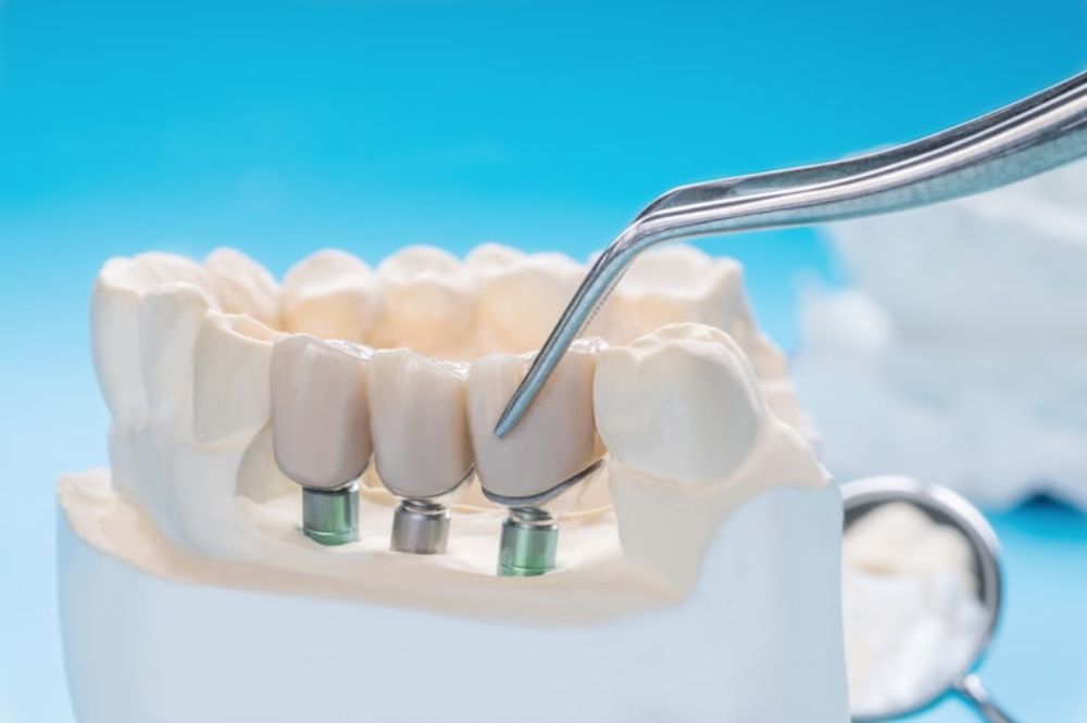 Candidate for a Dental Bridge