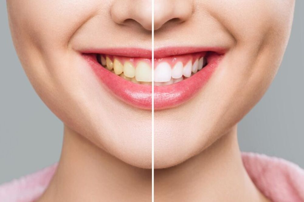 Get Professional Teeth Whitening